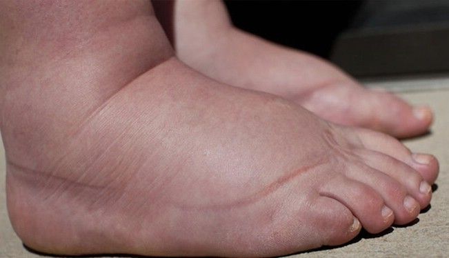 Bài thuốc Kê minh tán gia phục linh điều trị phù thũng và cước khí