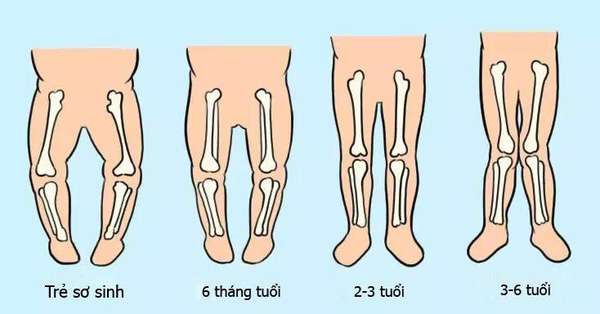 Thay đổi khung xương ở trẻ và biến dạng thành ngực
