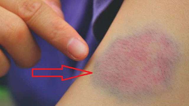 Xuất huyết và vết bầm máu ở trẻ em có nguy hiểm không?