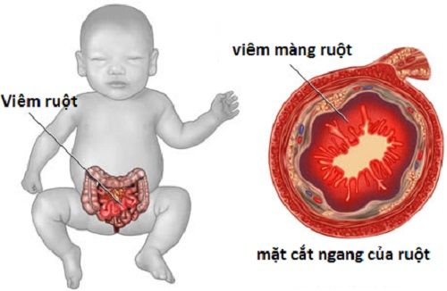 Bài thuốc kiến trung thang điều trị chứng viêm ruột mạn tính